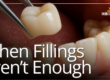 dental crown being placed in mouth